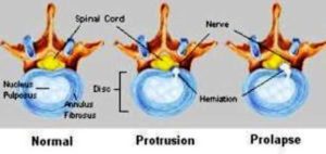normal protrusion prolapse